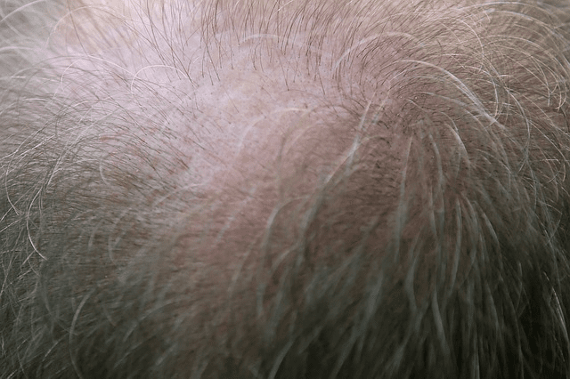 Hair Loss with Hypothyroidism balding top of the head